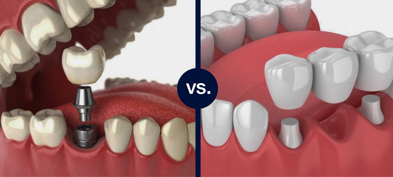 Dental Implant Vs Bridge Choosing The Right Option KL Dental