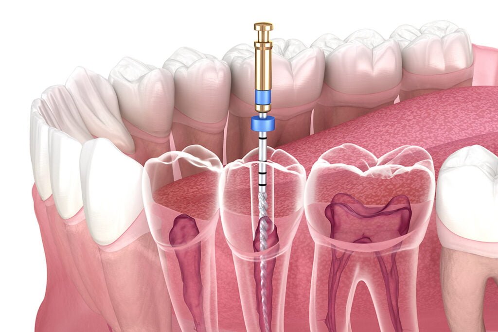 Root Canal Treatment Cost and Procedure | KL Dental